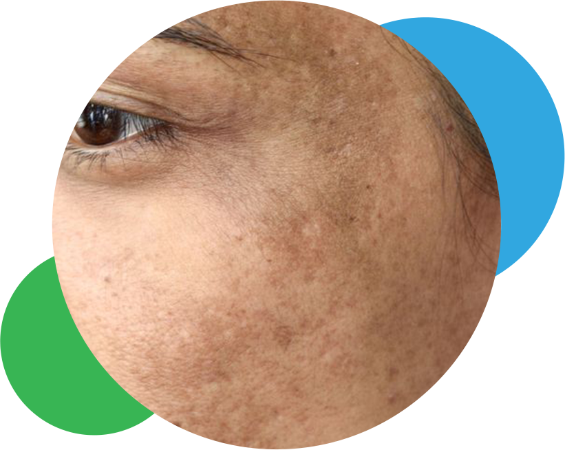 foto melasma